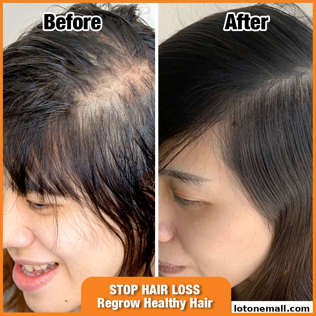 A split image showing a 'before' and 'after' of hair loss treatment, with text promoting hair regrowth.